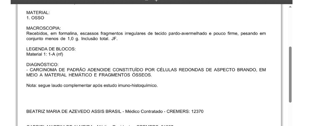 Laudo de biópsia óssea mostrando carcinoma de padrão adenoide