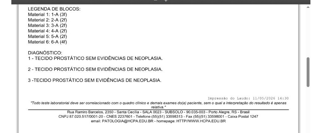 Laudo de biópsia prostática mostrando 6 fragmentos sem neoplasia